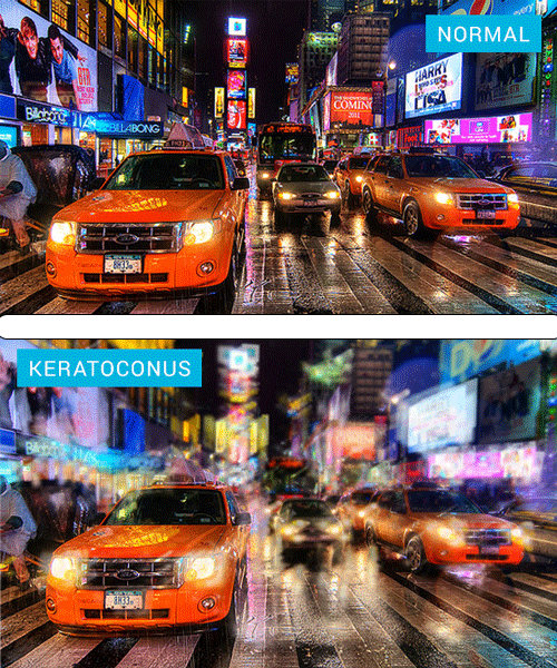 Side-by-side comparison of normal vision versus vision with keratoconus — light scattering causes significant blur and ghosting