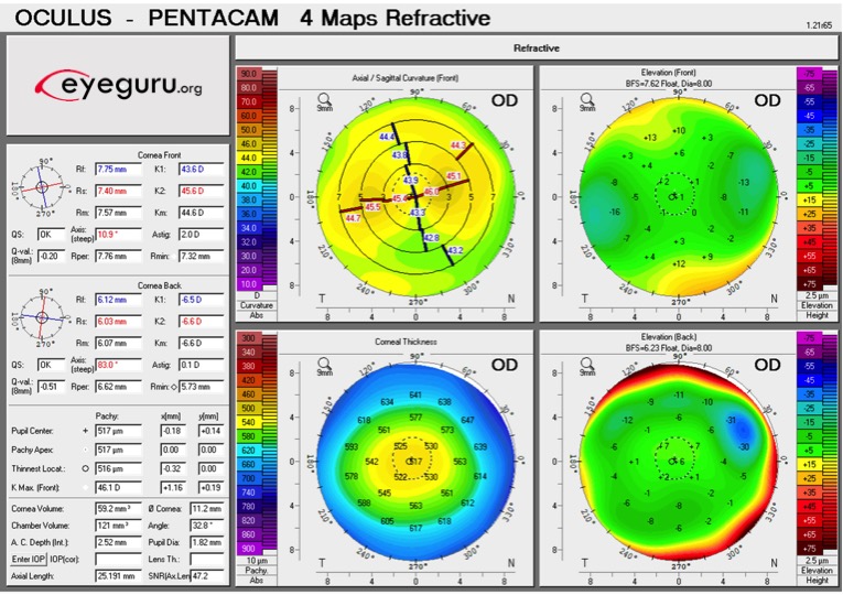 Pentacam 4-map refractive display showing axial curvature, elevation, and corneal thickness maps for a keratoconus patient